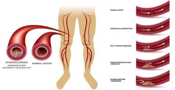 7 Simple Ways You Can Unclog Your Arteries Naturally | Non-Stop Healthy