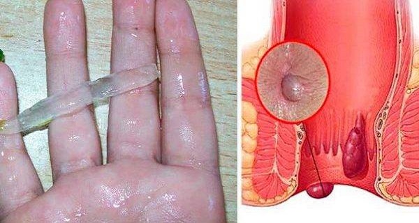 THIS IS THE BEST NATURAL CURE FOR HEMORRHOIDS! EVEN THE